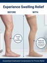sigvaris-compression-stockings-edema-leg-swelling-relief-before-after.jpg