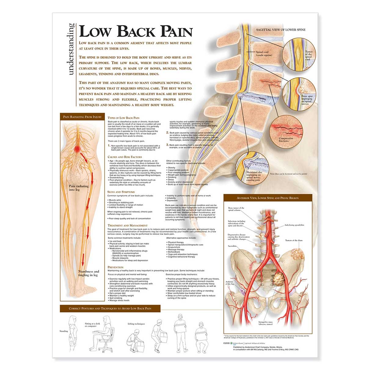 Open Box Understanding Low Back Pain Anatomical Chart-Paper