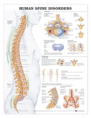 Open Box Human Spine Disorders Anatomical Chart-Laminated