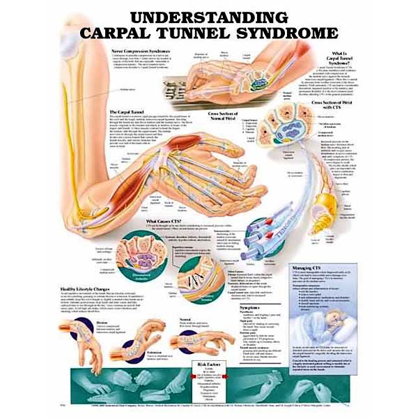 OPEN BOX Understanding Carpal Tunnel Syndrome – Anatomical Chart (Paper)